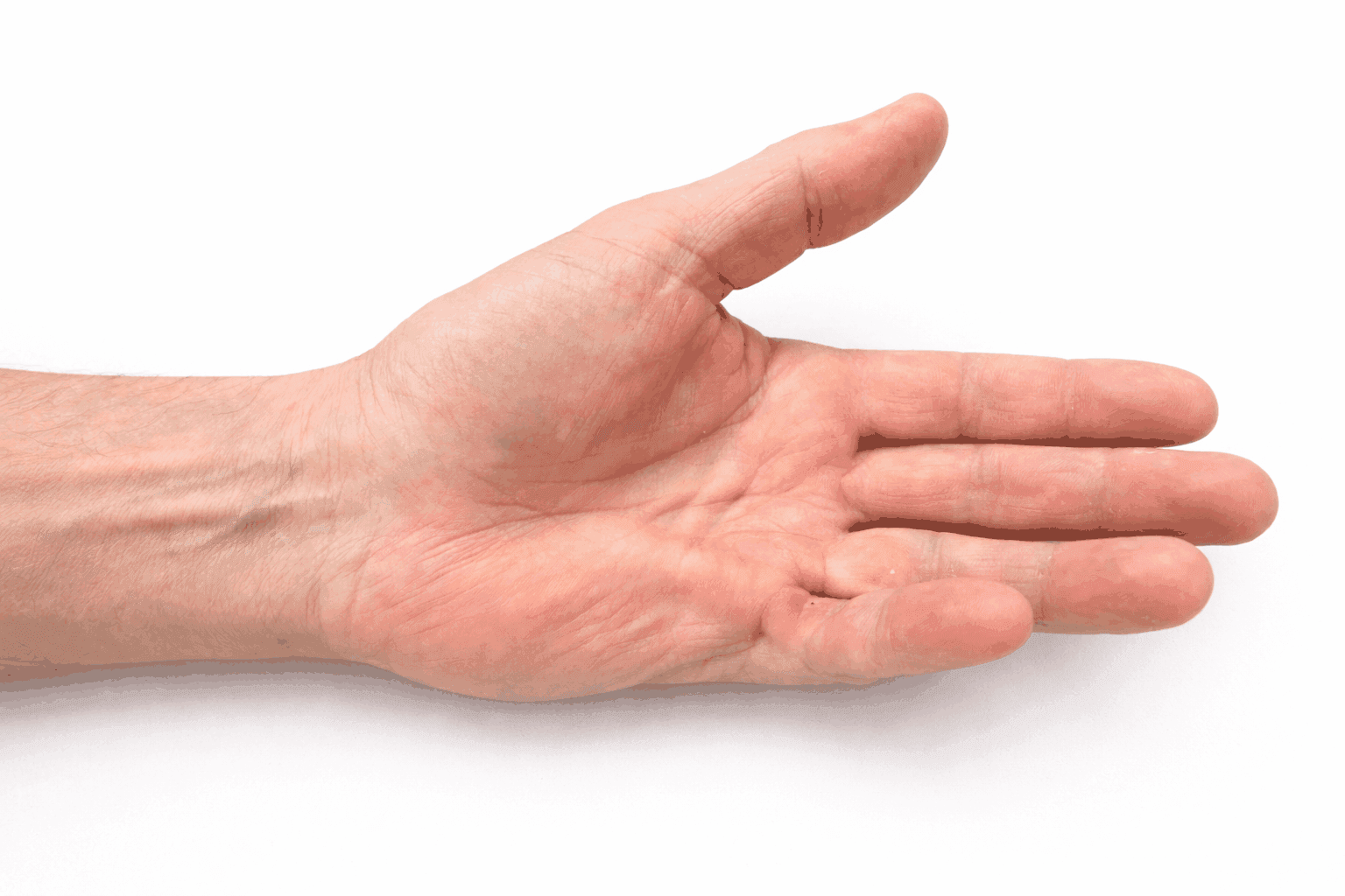 Read more: Dupuytren Contracture: Finger Bending and Timing of Treatment